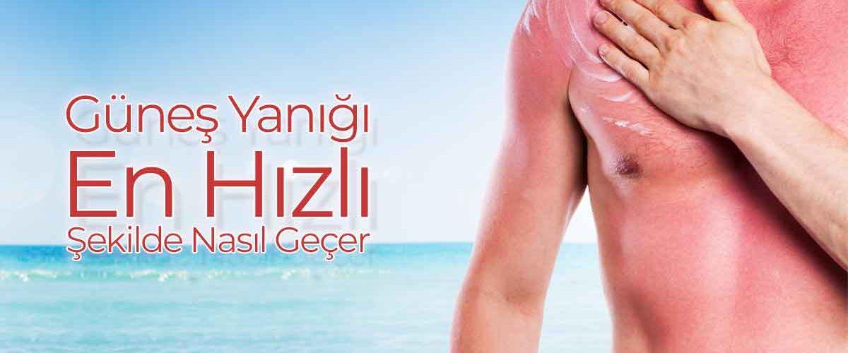 Gunes-Yanigi-En-Hizli-Sekilde-Nasil-Gecer
